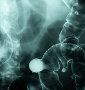 Cancer colo-rectal